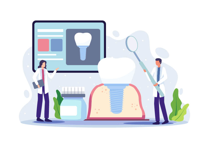 Wie Zahnimplantate sich unterscheiden